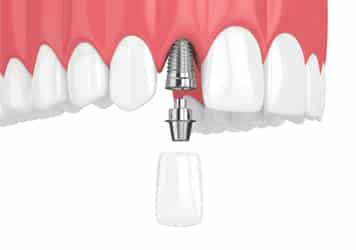 dental implants grovetown georgia