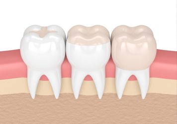 dental-sealants