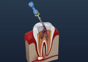 root-canal root canal grovetown endodontist